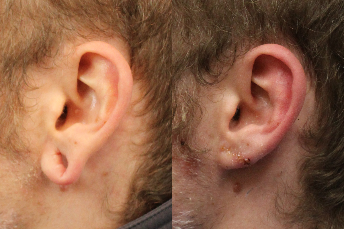 Earlobe Repair Before & After Gallery - Patient 247884 - Image 4