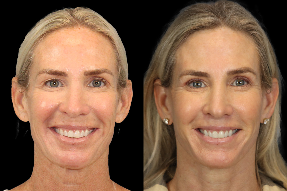 Lip Lift Before & After Gallery - Patient 354795 - Image 2