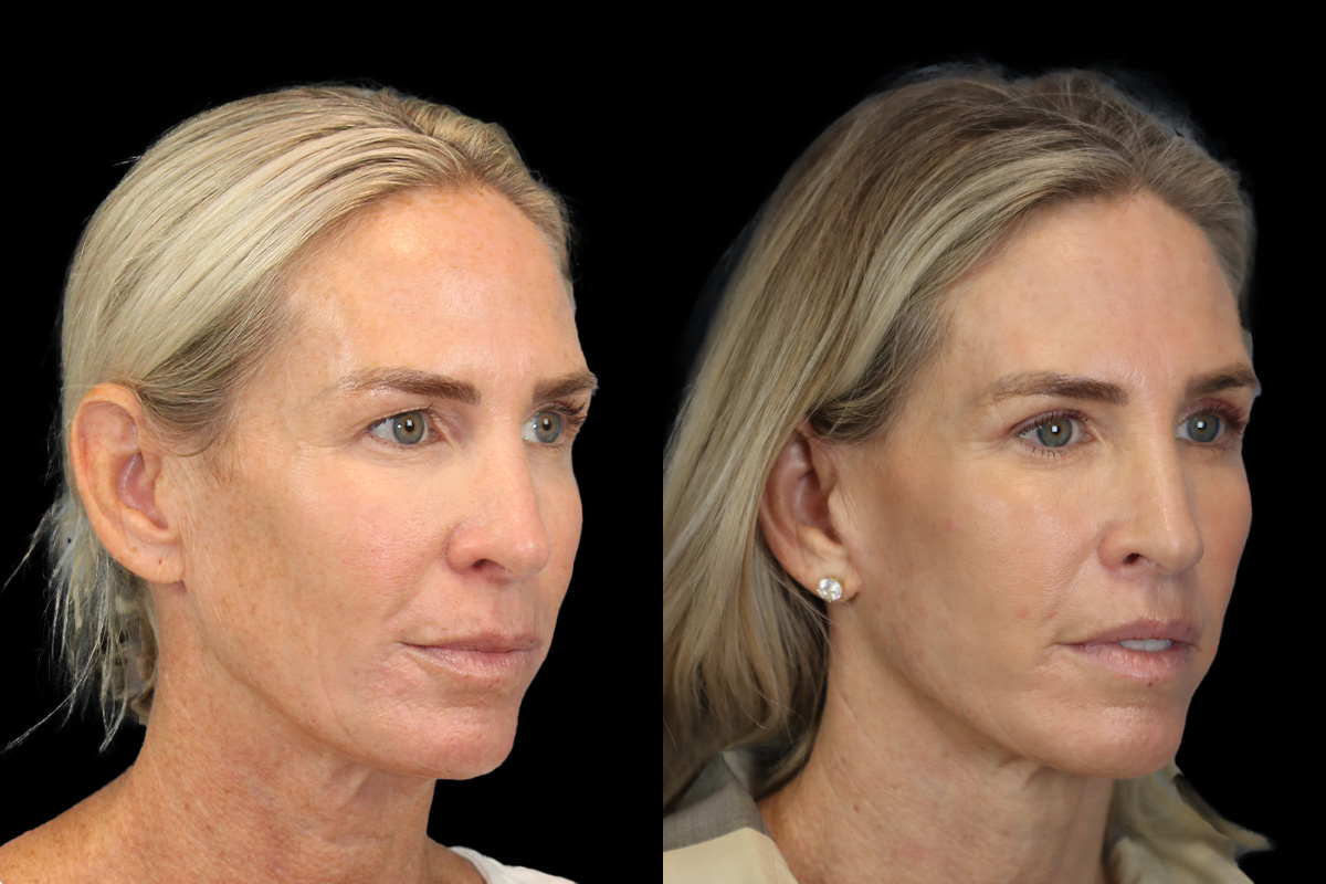 Lip Lift Before & After Gallery - Patient 354795 - Image 3