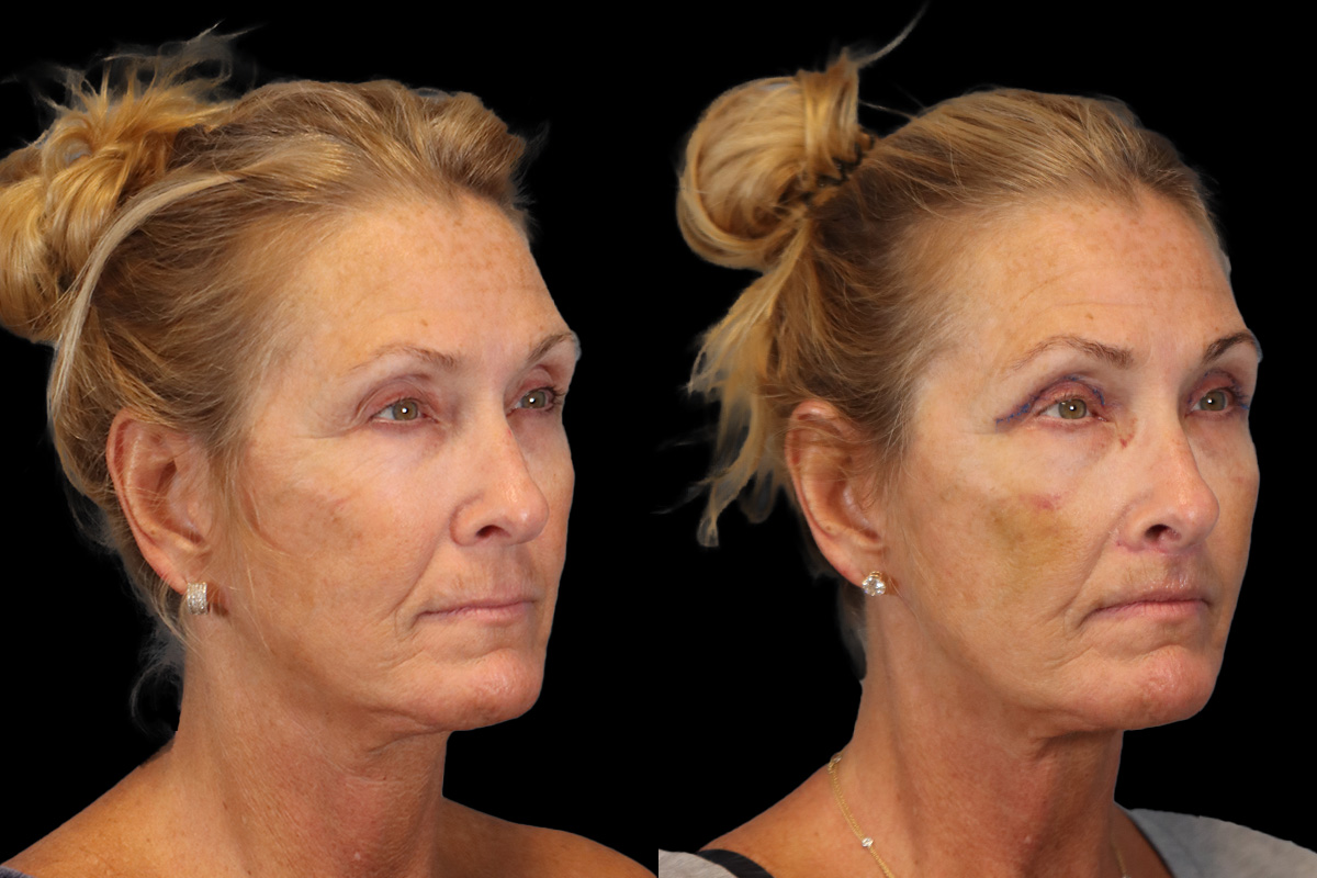 Lip Lift Before & After Gallery - Patient 418601 - Image 3