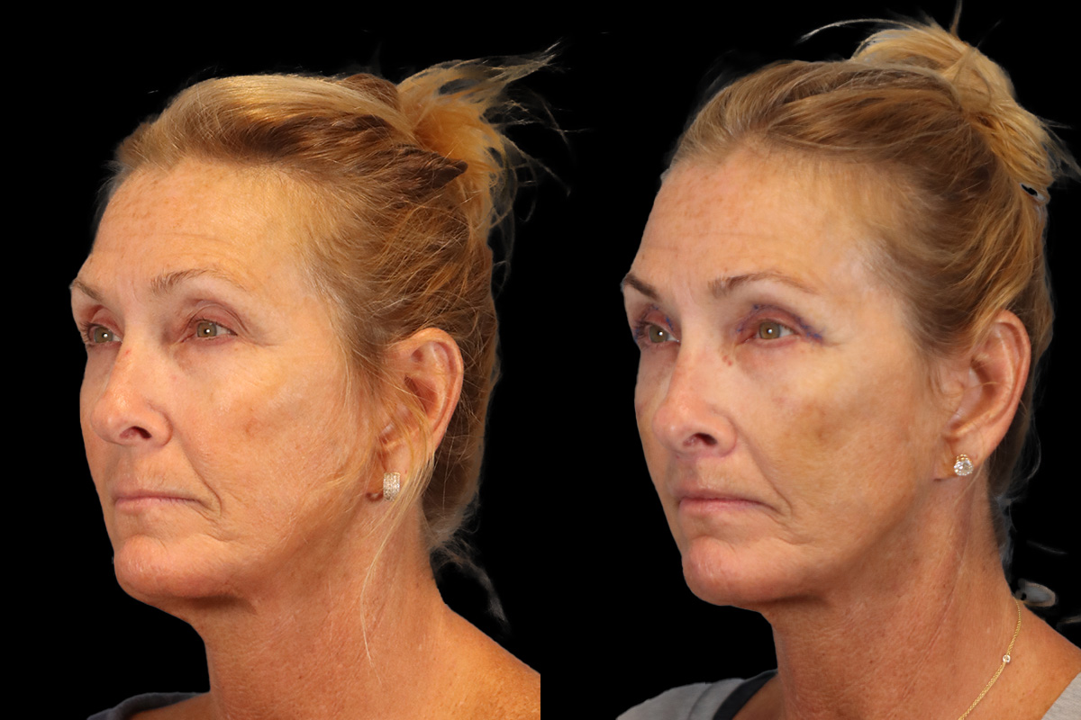 Lip Lift Before & After Gallery - Patient 418601 - Image 5