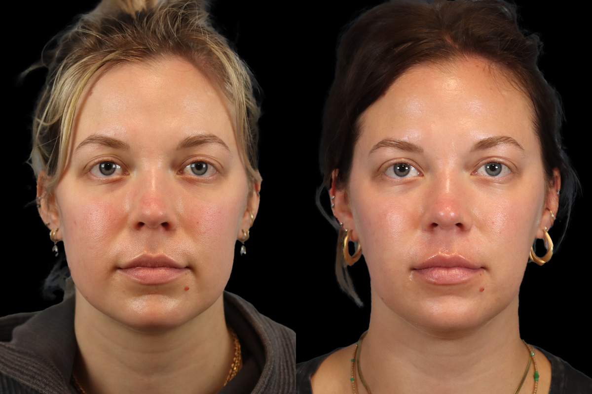 Buccal Fat Removal Before & After Gallery - Patient 182616 - Image 1