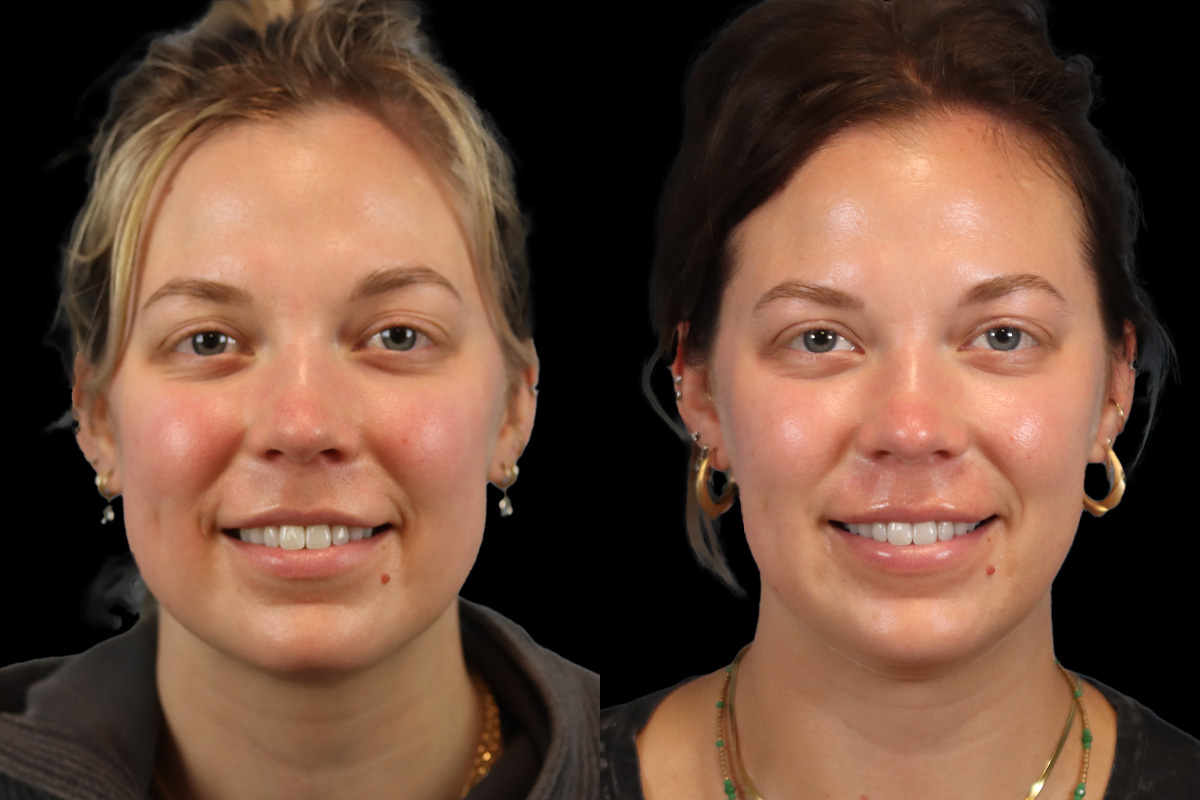 Buccal Fat Removal Before & After Gallery - Patient 182616 - Image 2