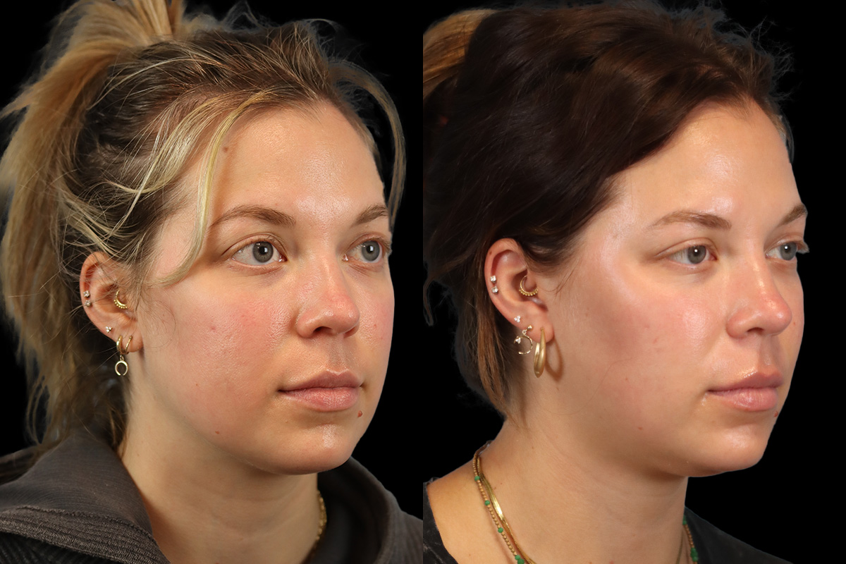 Buccal Fat Removal Before & After Gallery - Patient 182616 - Image 3
