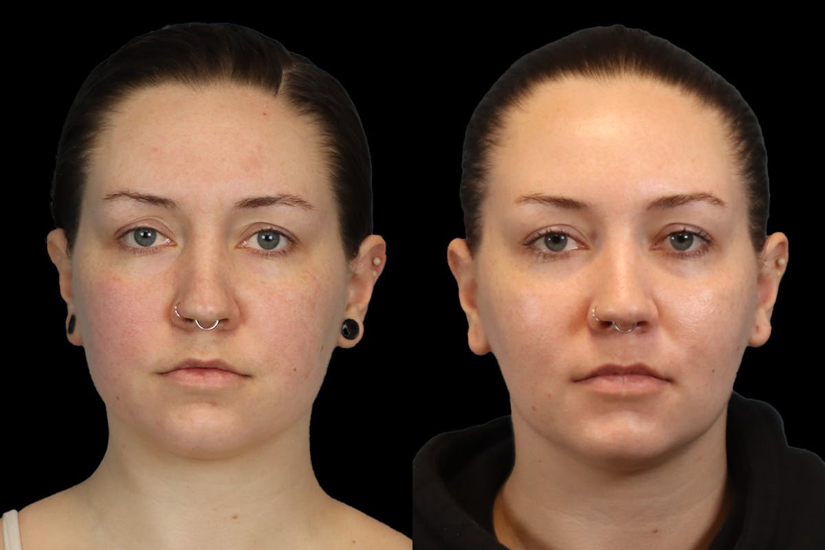 Buccal Fat Removal Before & After Gallery - Patient 112302 - Image 1