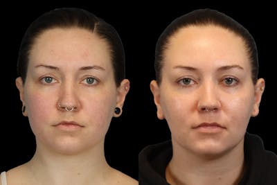 Buccal Fat Removal Before & After Gallery - Patient 112302 - Image 1