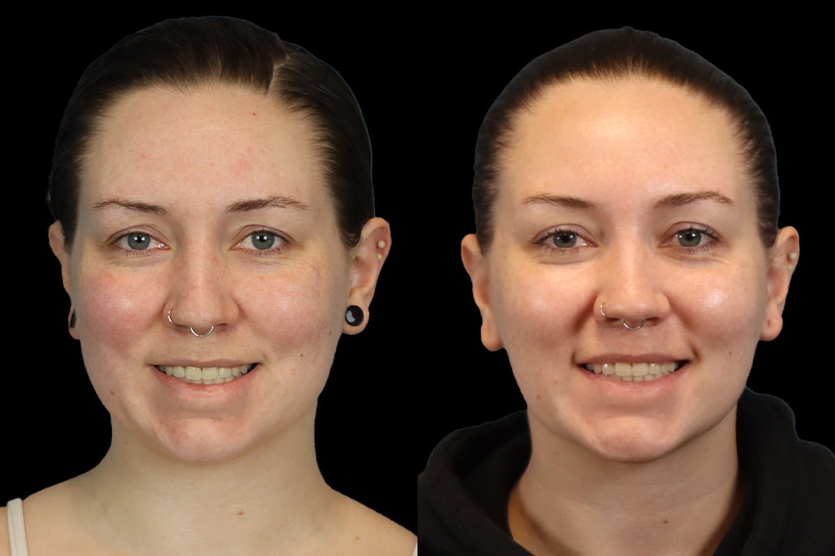 Buccal Fat Removal Before & After Gallery - Patient 112302 - Image 2