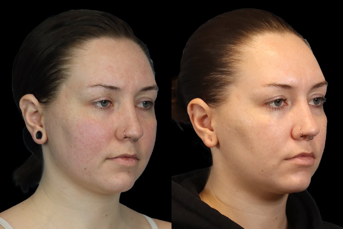 Buccal Fat Removal Before & After Gallery - Patient 112302 - Image 3