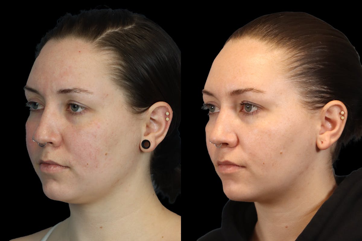 Buccal Fat Removal Before & After Gallery - Patient 112302 - Image 4