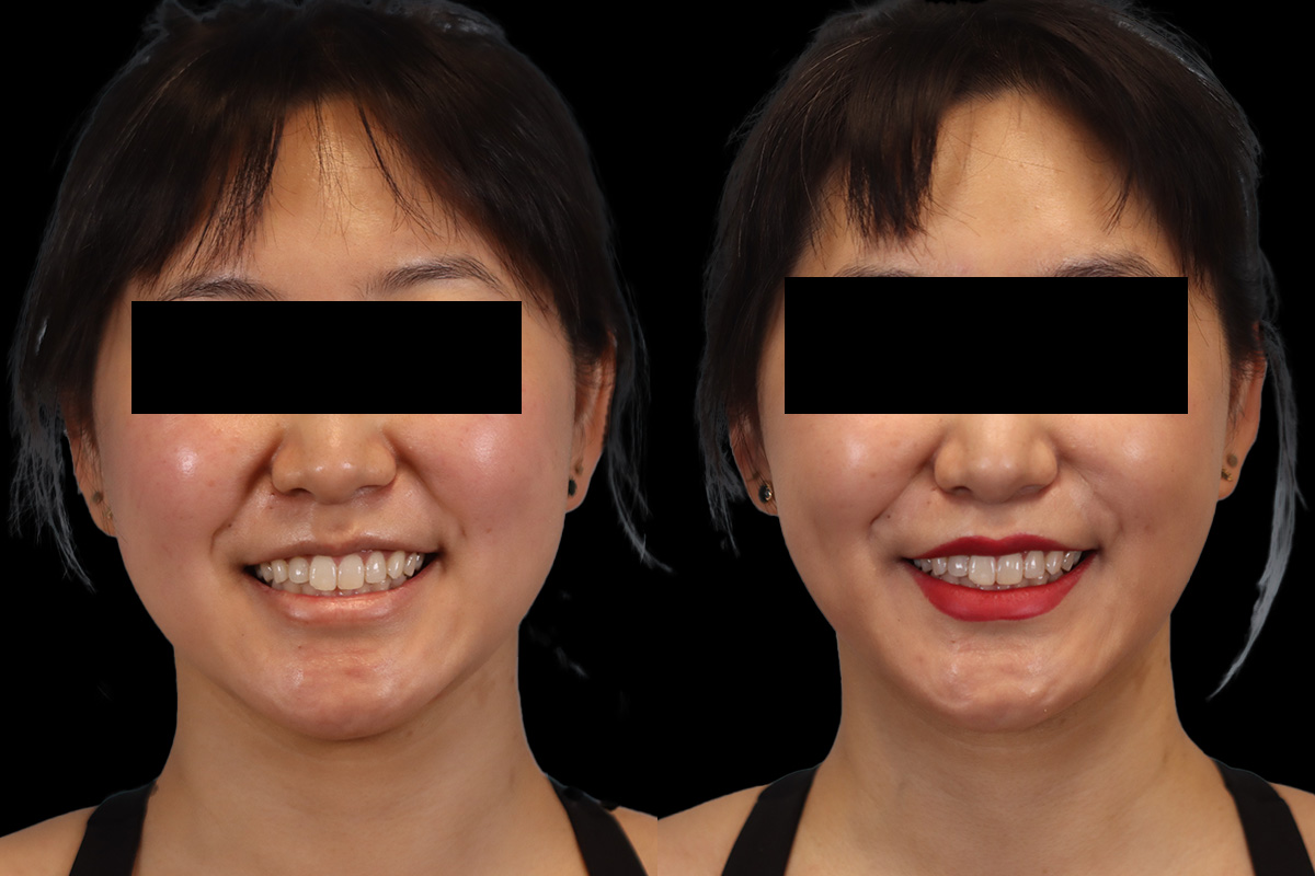 Buccal Fat Removal Before & After Gallery - Patient 150911 - Image 2