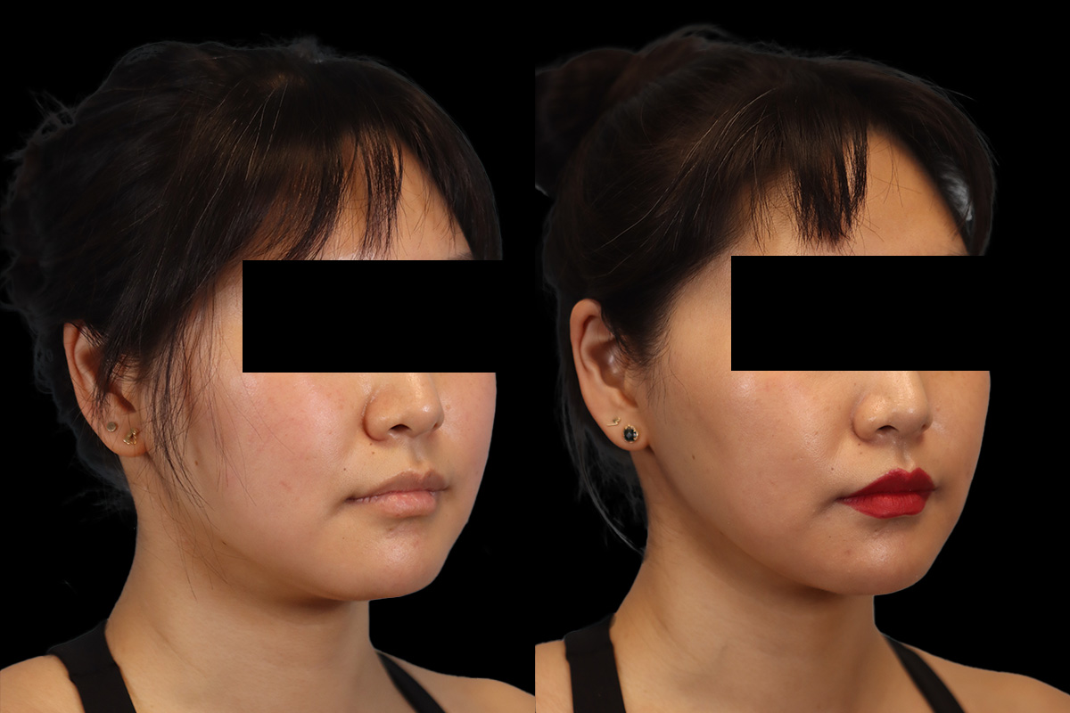 Buccal Fat Removal Before & After Gallery - Patient 150911 - Image 3