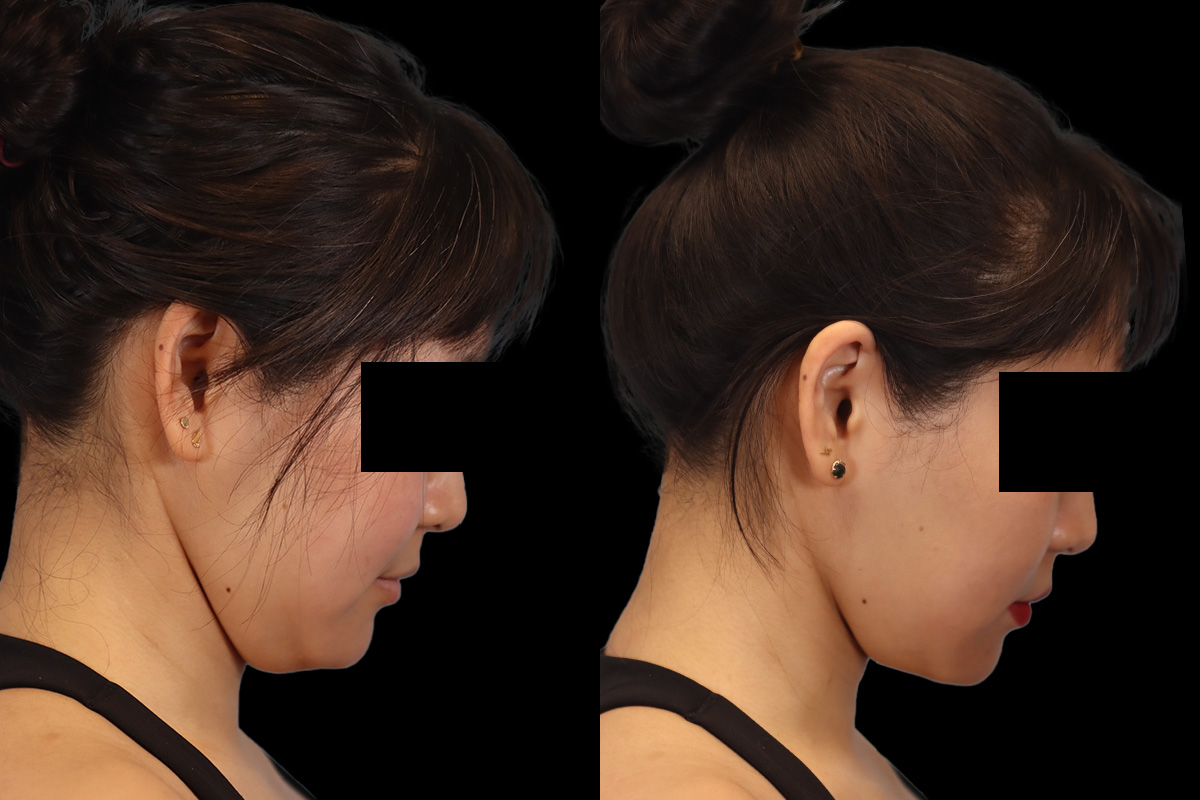 Buccal Fat Removal Before & After Gallery - Patient 150911 - Image 5