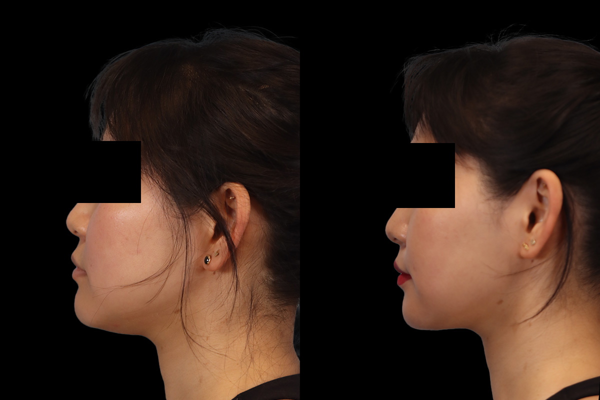 Buccal Fat Removal Before & After Gallery - Patient 150911 - Image 7