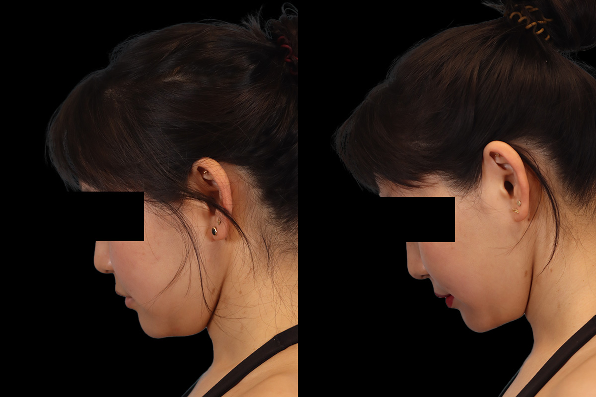 Buccal Fat Removal Before & After Gallery - Patient 150911 - Image 8