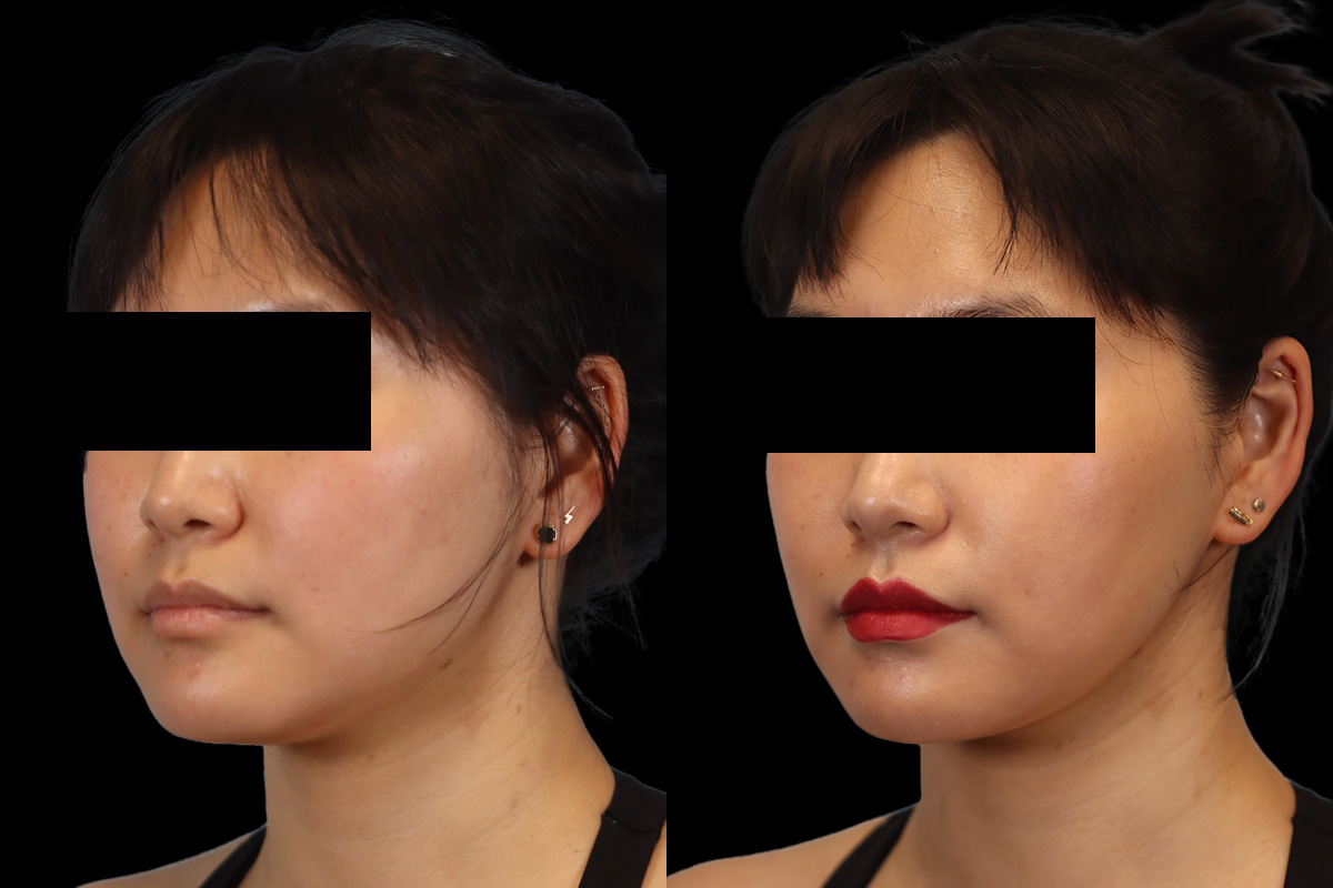 Buccal Fat Removal Before & After Gallery - Patient 150911 - Image 6