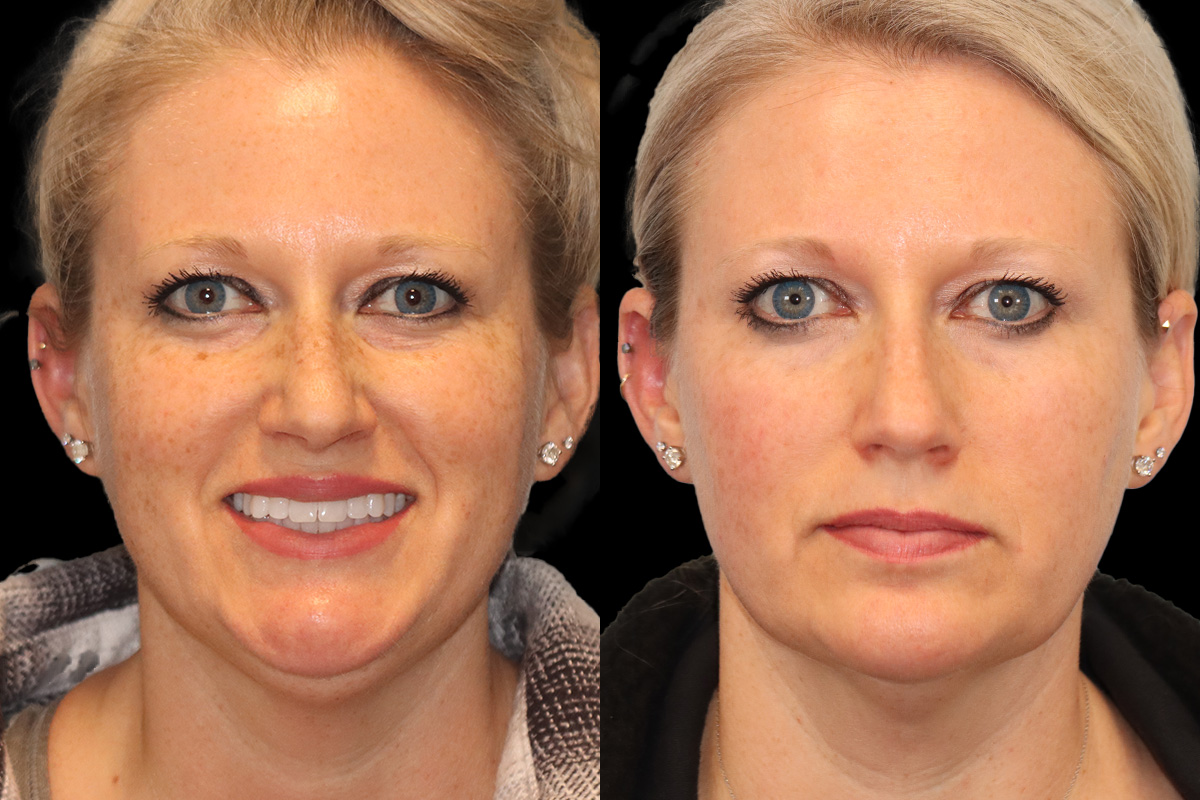 Photofacial Before & After Gallery - Patient 379313 - Image 1