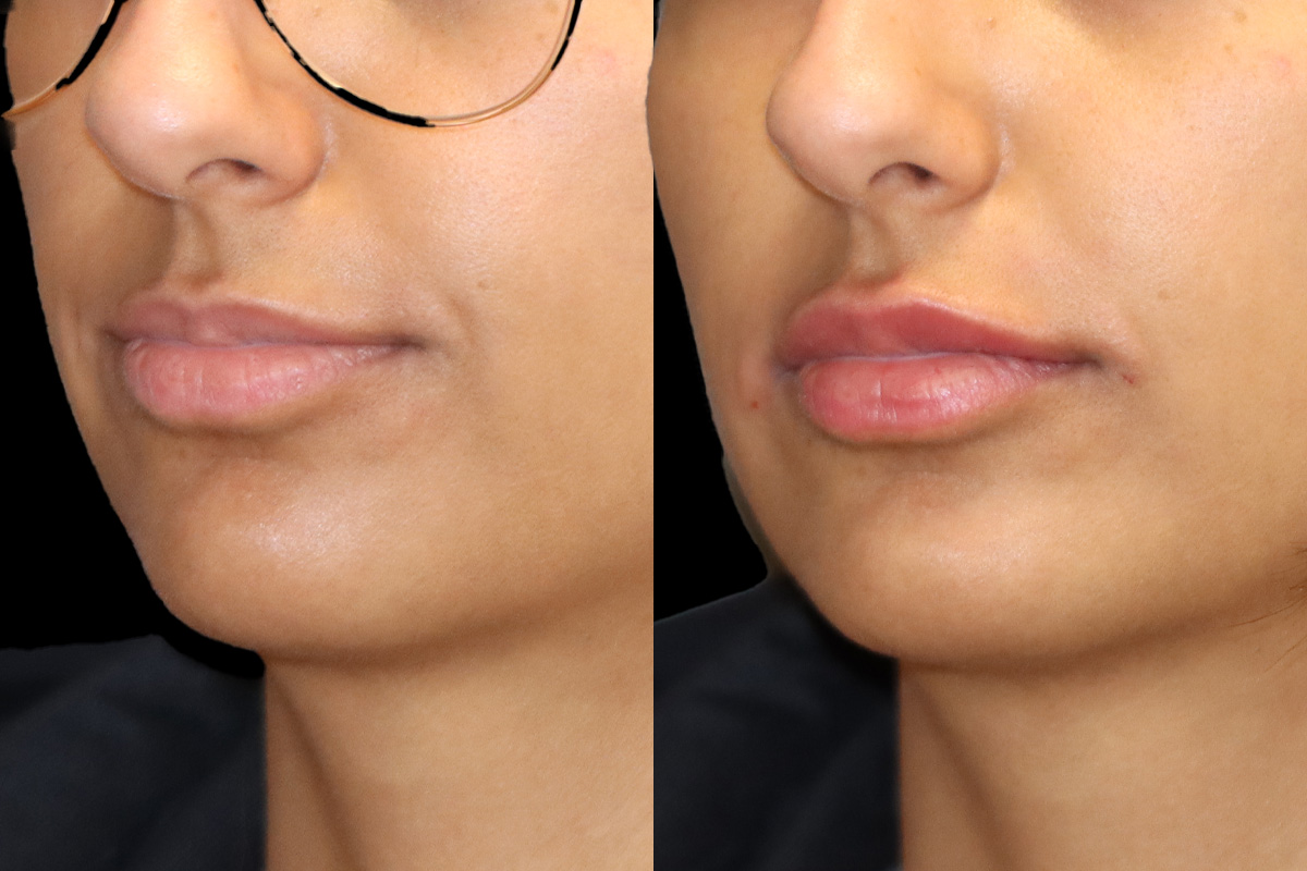 Lips Before & After Gallery - Patient 393448 - Image 2