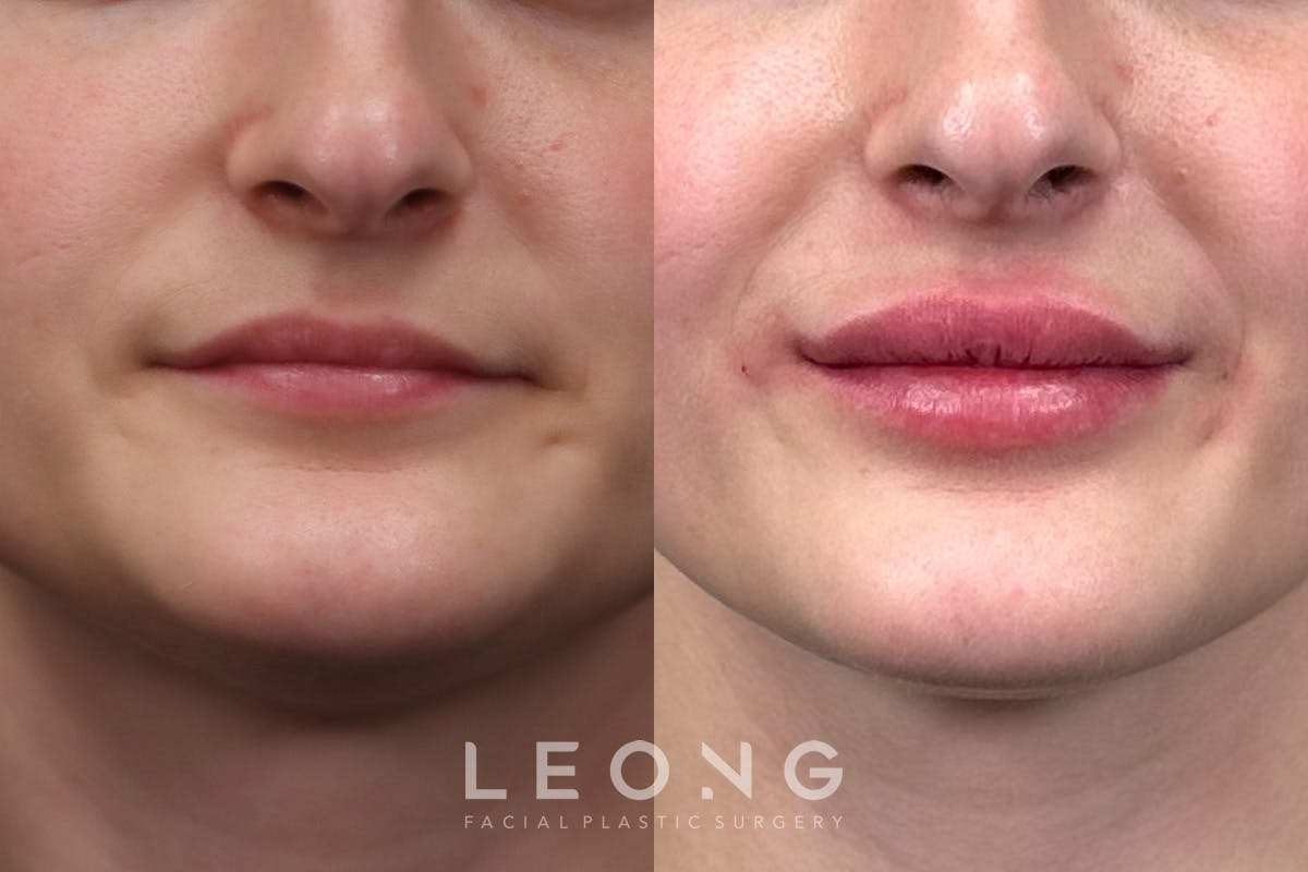 Alignment Lips Blocks Patient 140139 | Lips Before & After Photos | Leong Plastic Surgery NYC