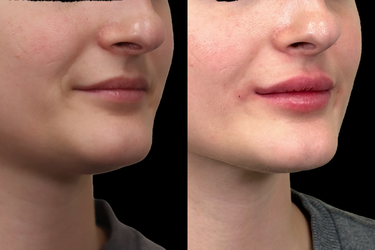 Lips Before & After Gallery - Patient 140139 - Image 2