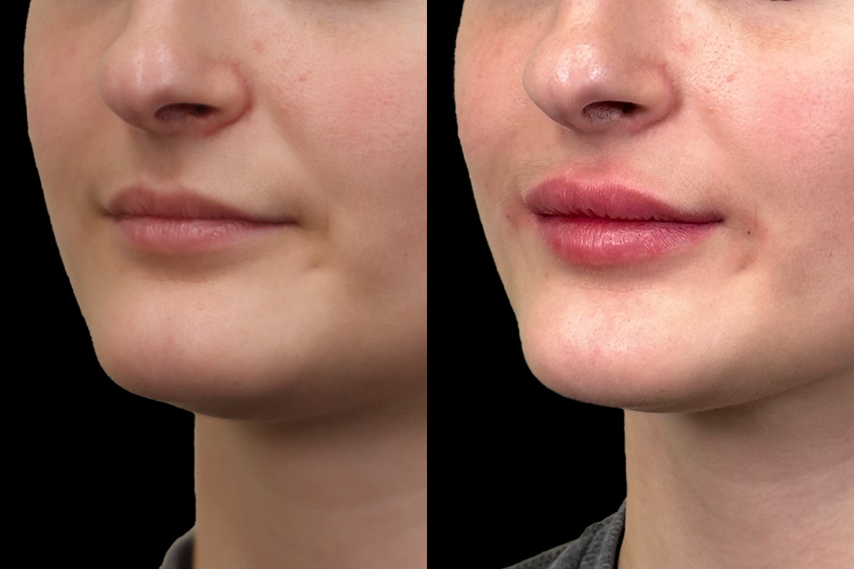 Lips Before & After Gallery - Patient 140139 - Image 3