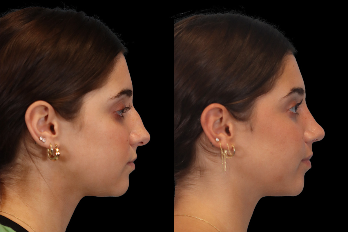 Nose Before & After Gallery - Patient 353871 - Image 4