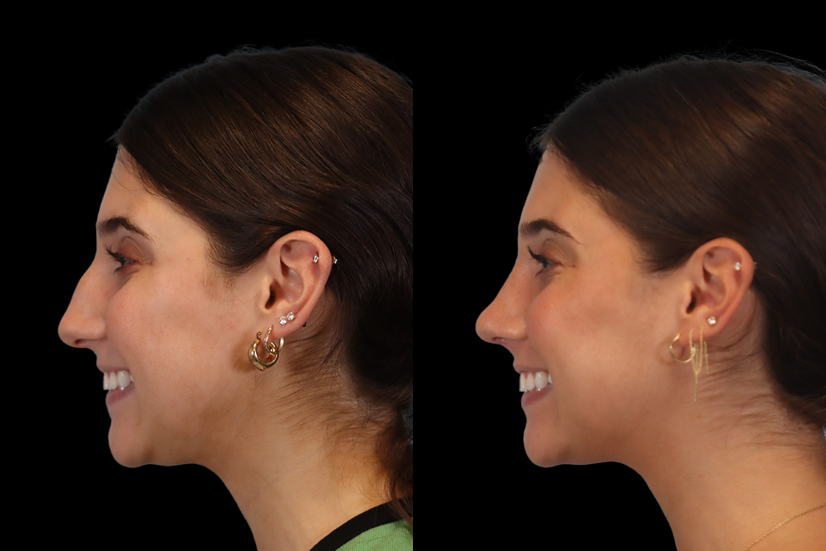 Nose Before & After Gallery - Patient 353871 - Image 8