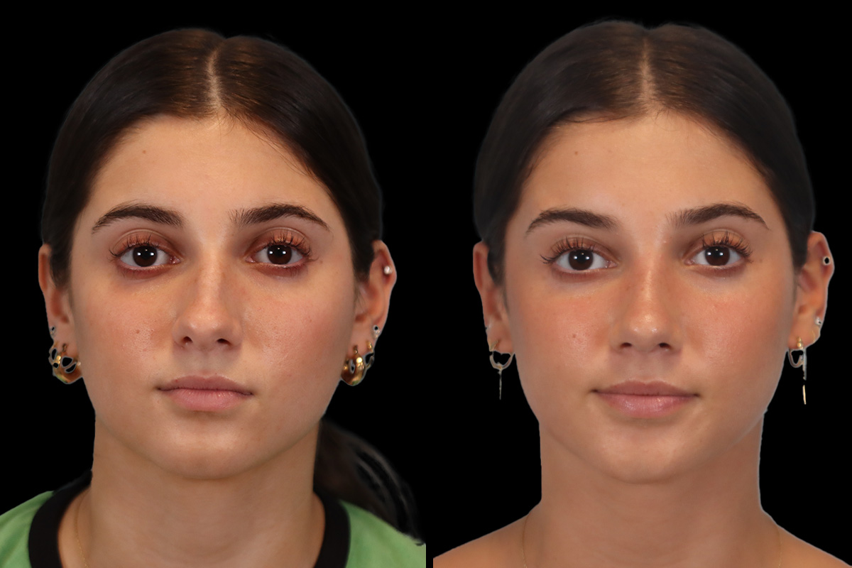 Nose Before & After Gallery - Patient 353871 - Image 1