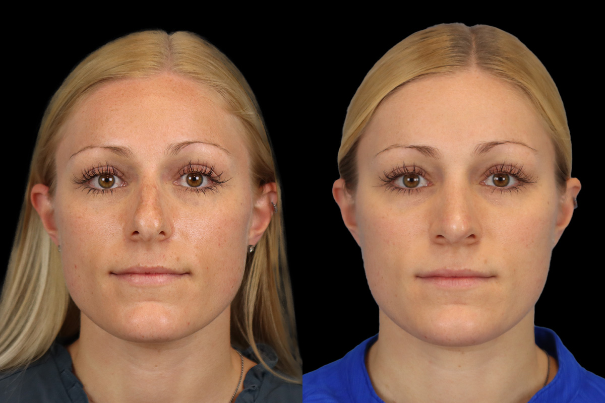 Nose Before & After Gallery - Patient 138220 - Image 1