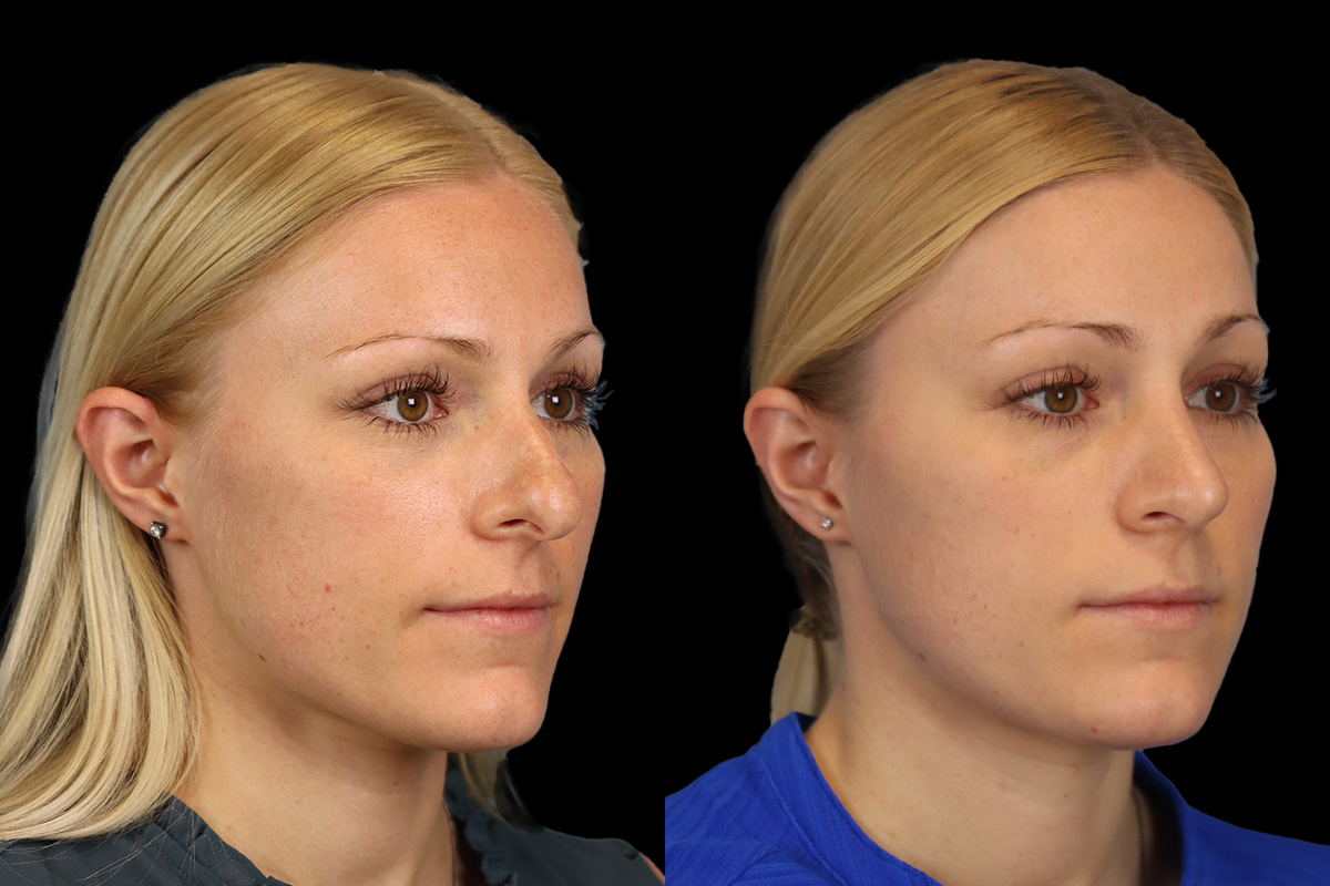Nose Before & After Gallery - Patient 138220 - Image 2