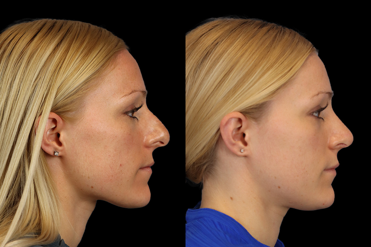 Nose Before & After Gallery - Patient 138220 - Image 3