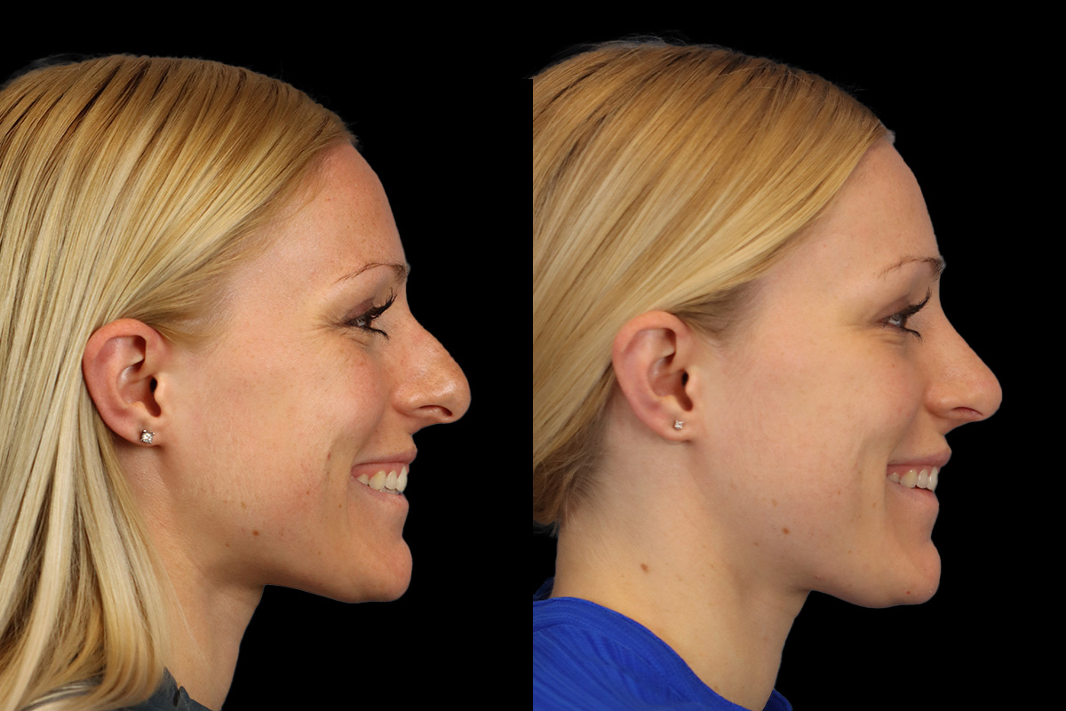 Nose Before & After Gallery - Patient 138220 - Image 4
