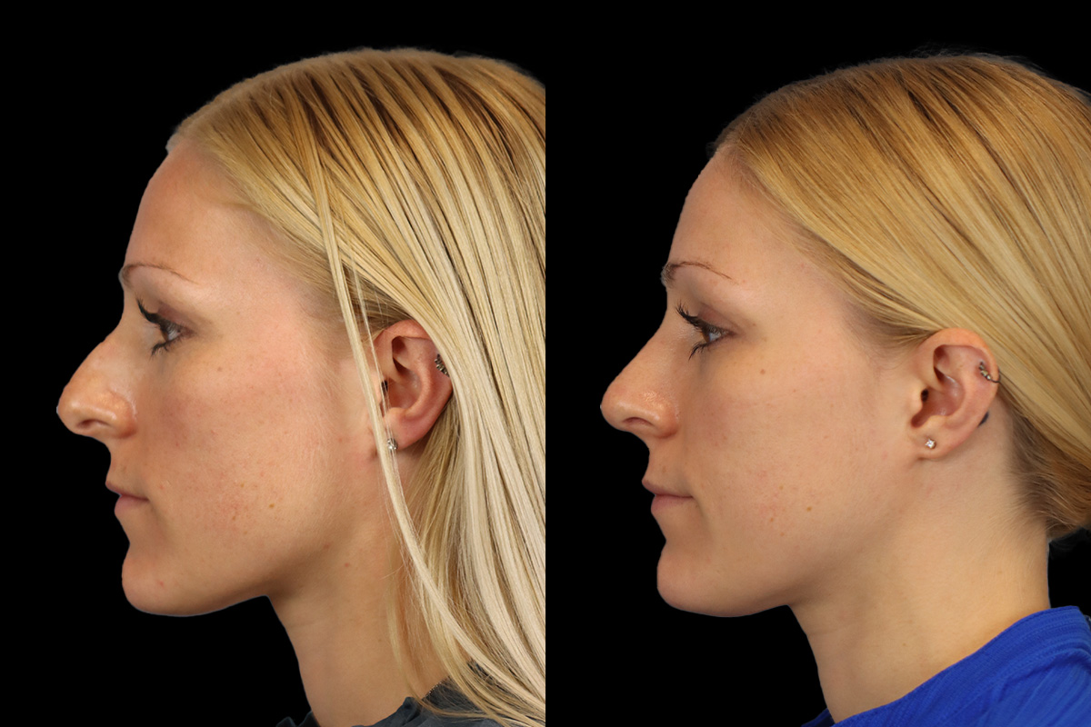 Nose Before & After Gallery - Patient 138220 - Image 6