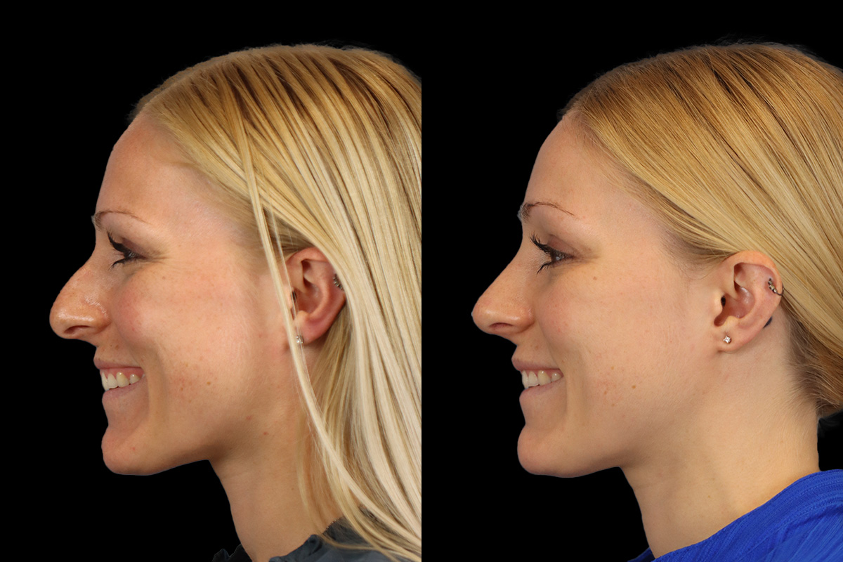 Nose Before & After Gallery - Patient 138220 - Image 7