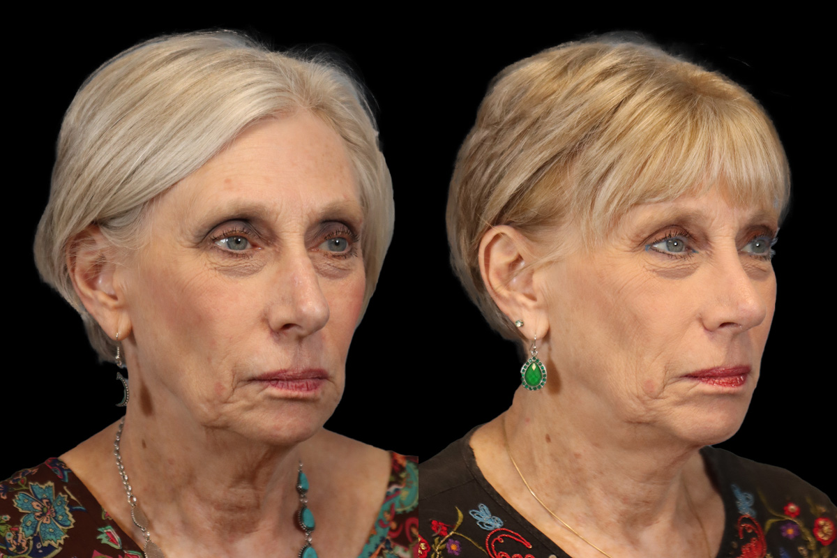 Nose Before & After Gallery - Patient 638576 - Image 2