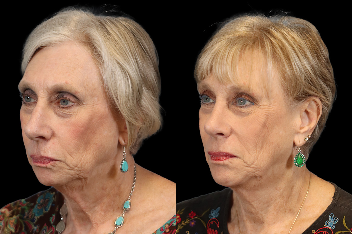 Nose Before & After Gallery - Patient 638576 - Image 4
