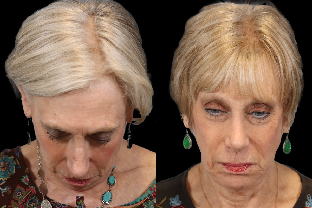 Nose Before & After Gallery - Patient 638576 - Image 6