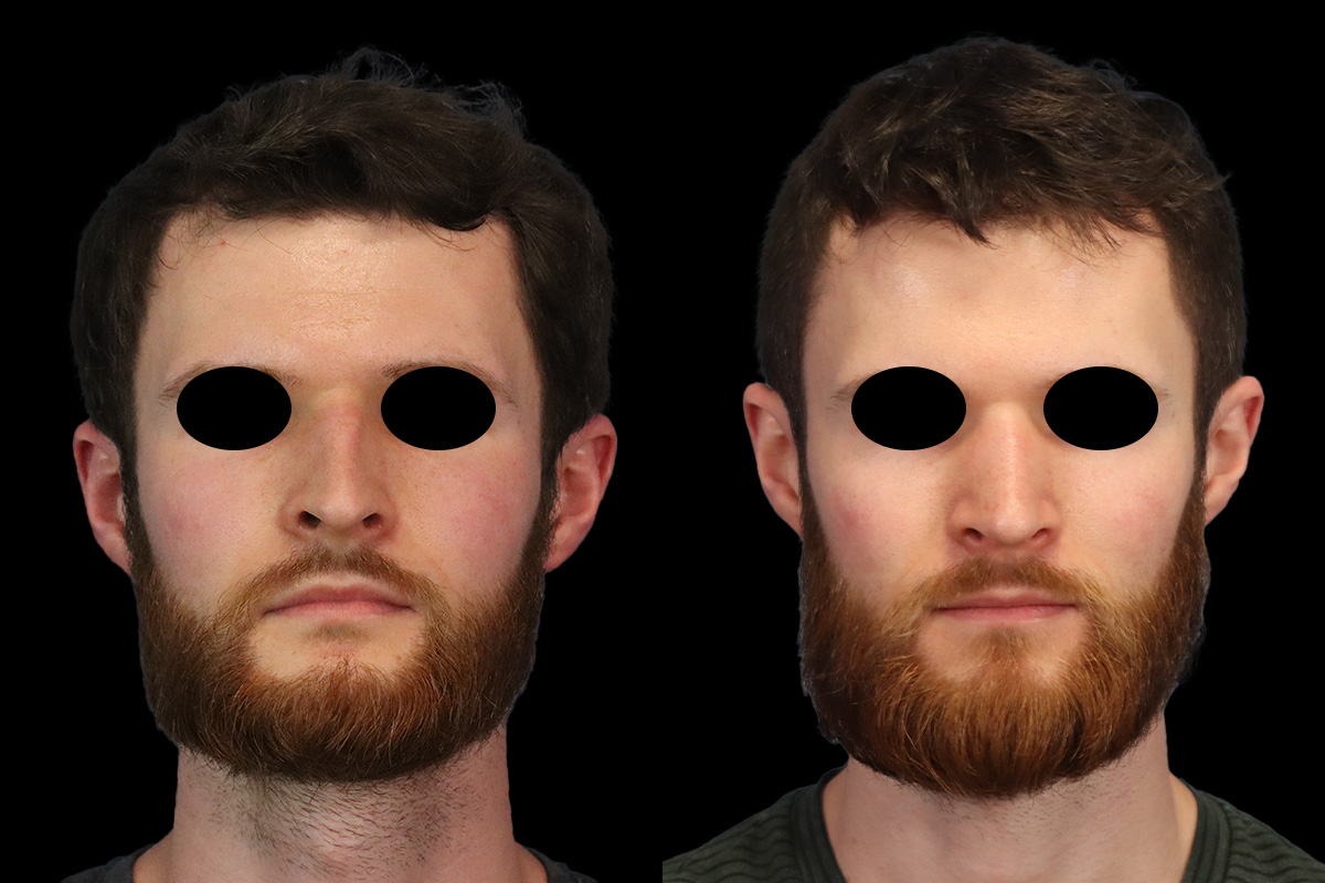 Nose Before & After Gallery - Patient 122685 - Image 1