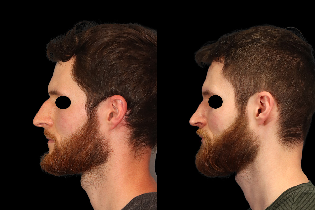 Nose Before & After Gallery - Patient 122685 - Image 5