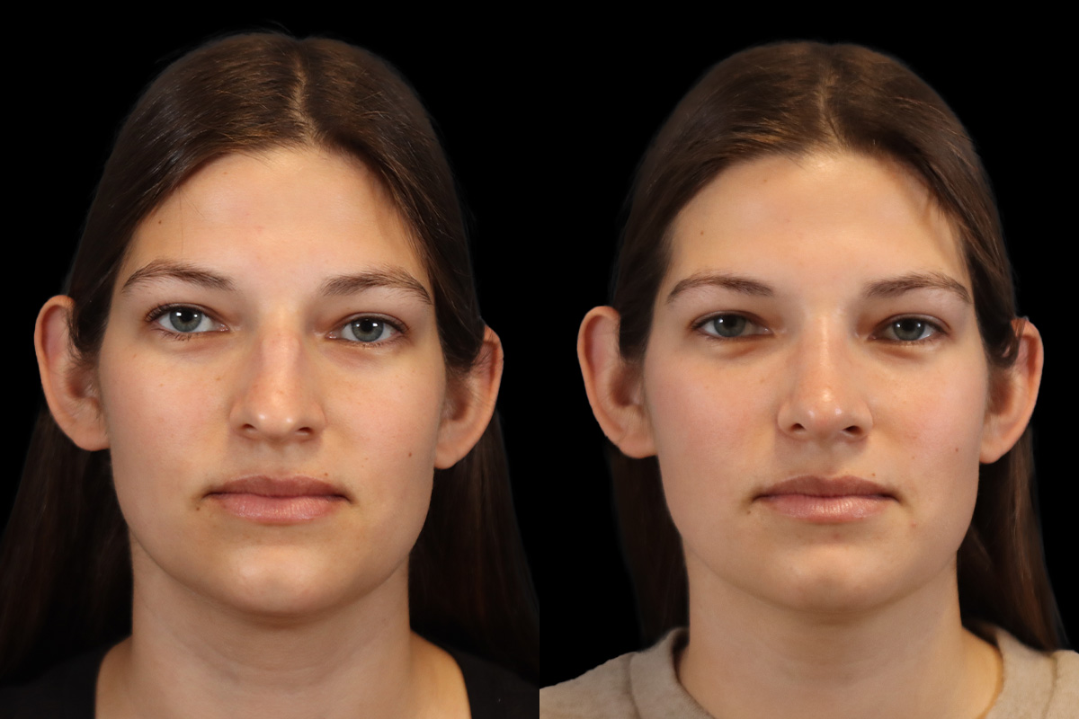 Nose Before & After Gallery - Patient 124010 - Image 1