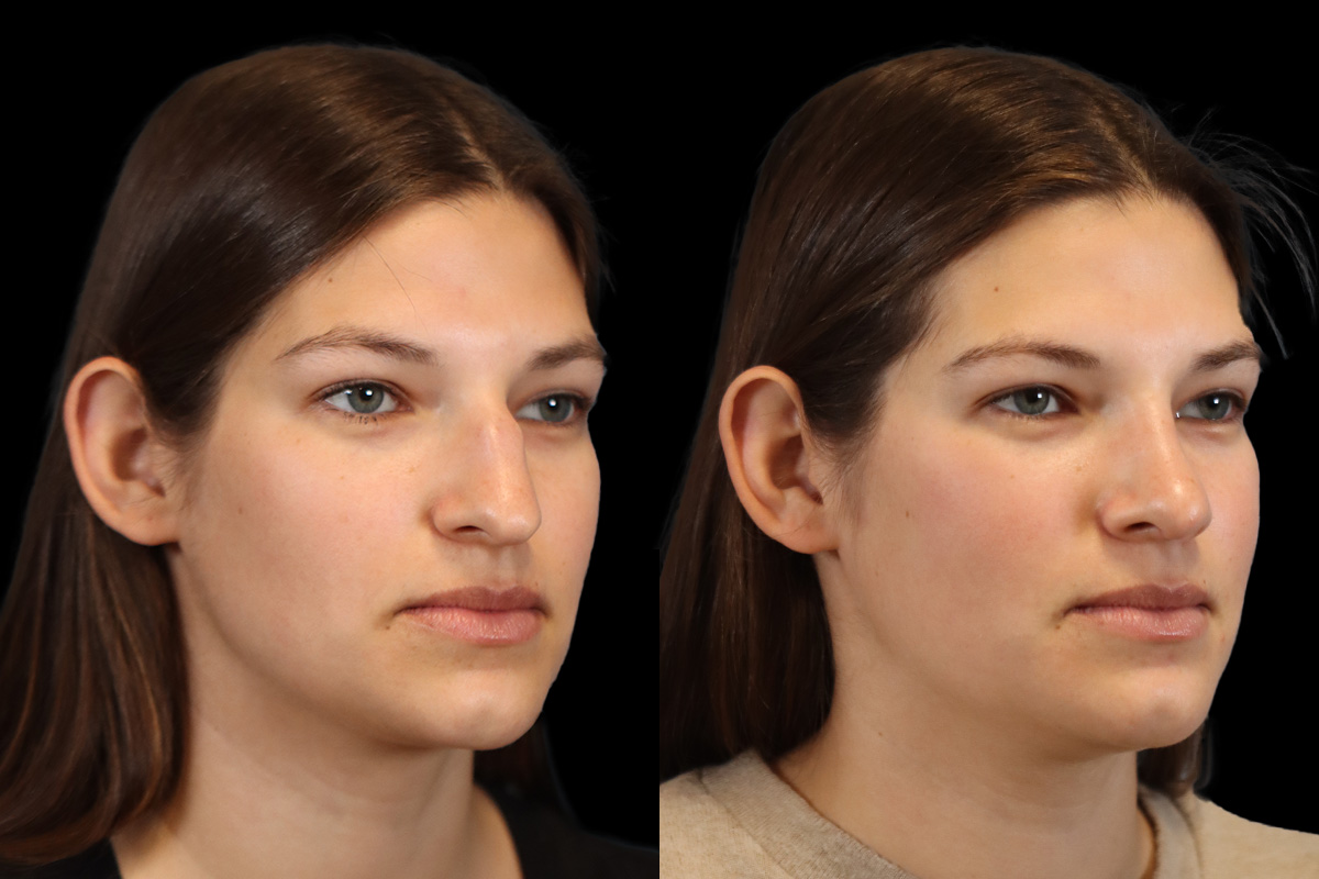 Nose Before & After Gallery - Patient 124010 - Image 3