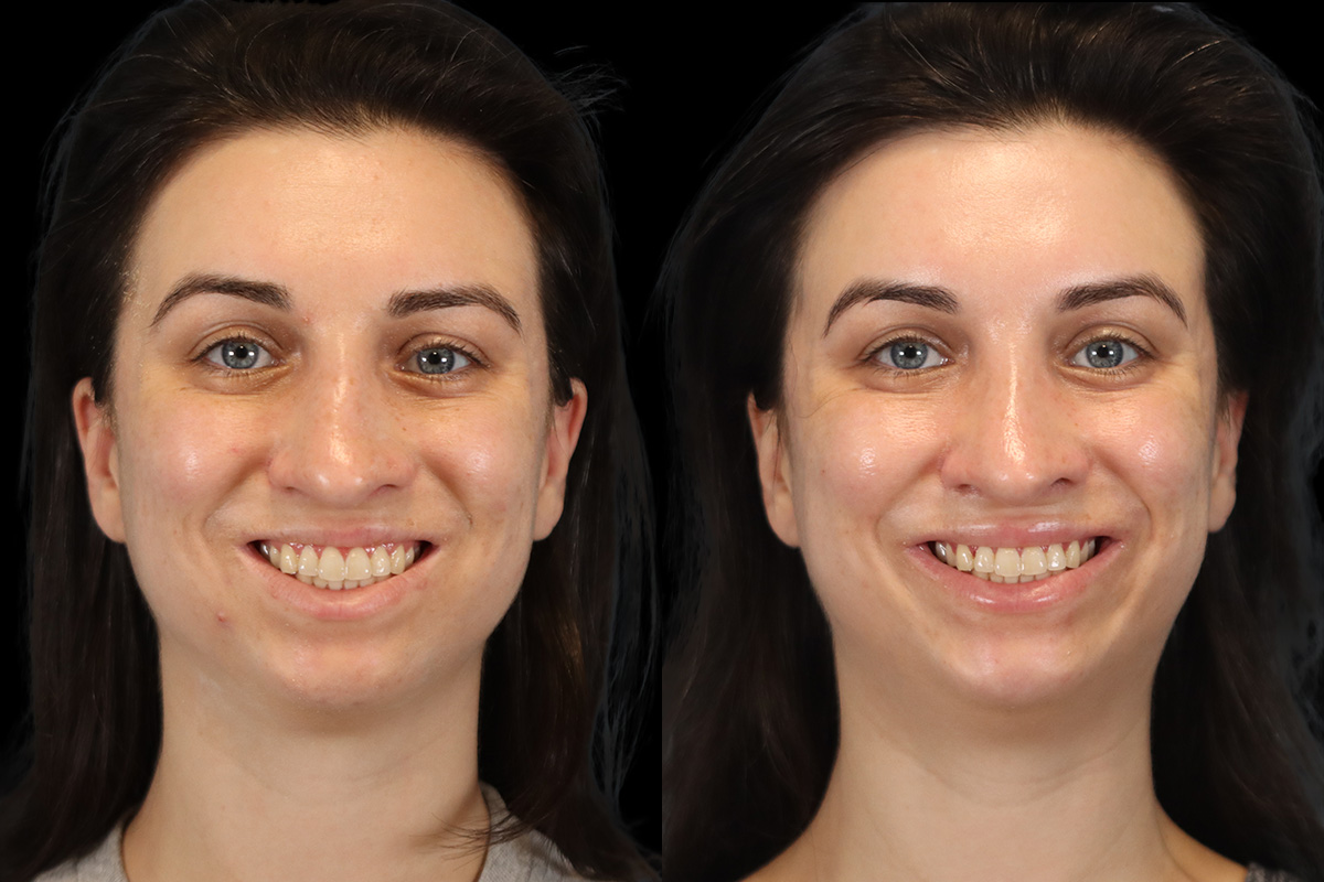 Nose Before & After Gallery - Patient 379393 - Image 2