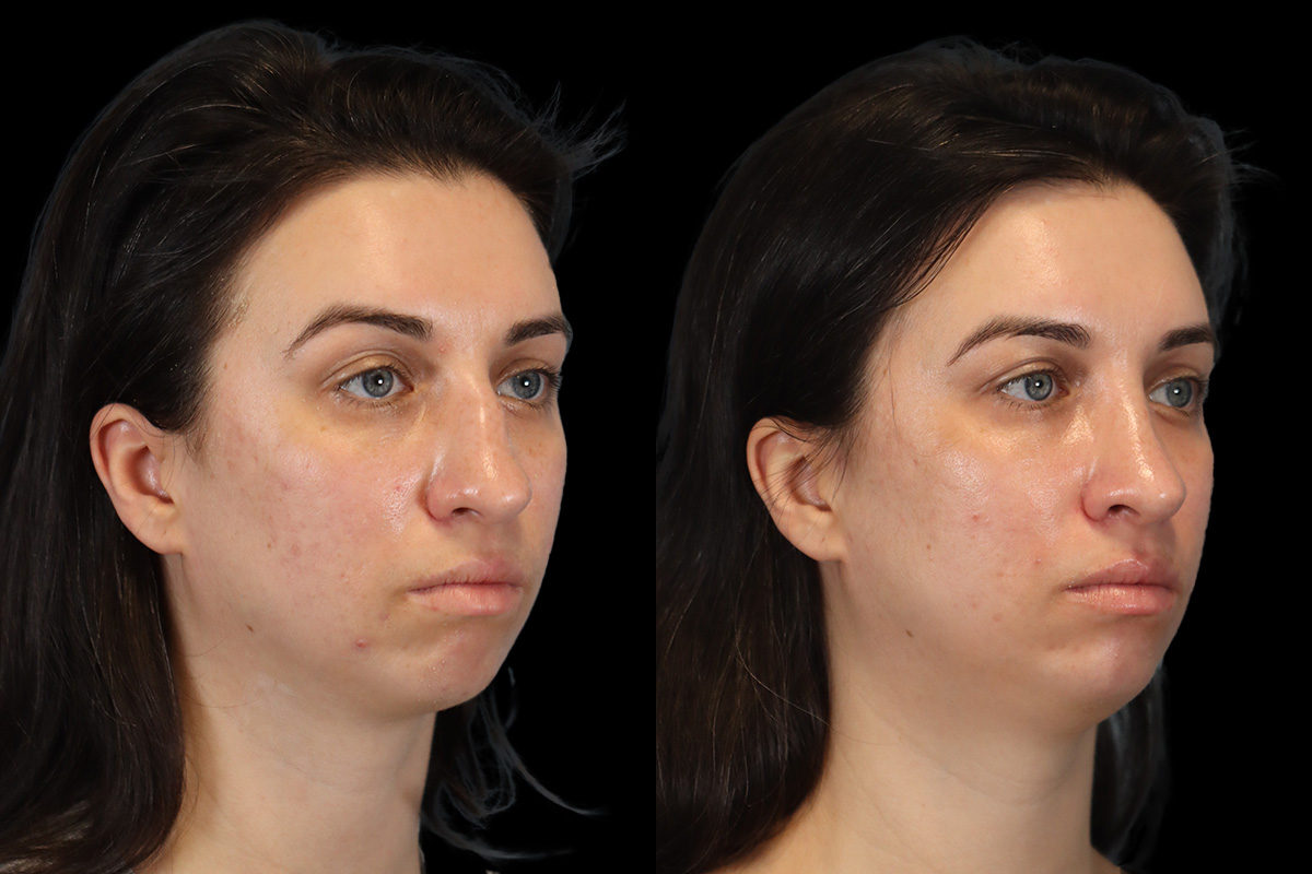 Nose Before & After Gallery - Patient 379393 - Image 3