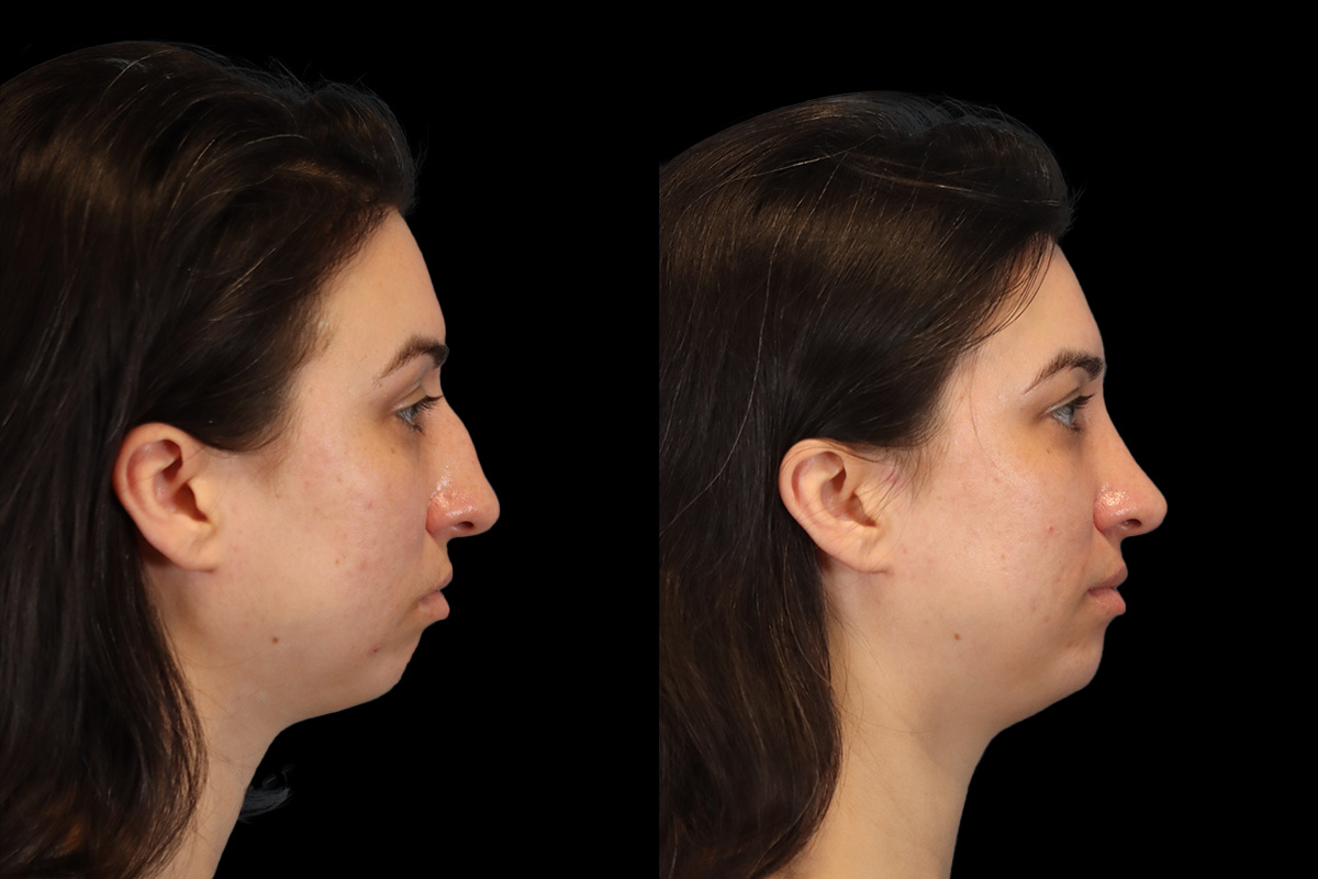 Nose Before & After Gallery - Patient 379393 - Image 4