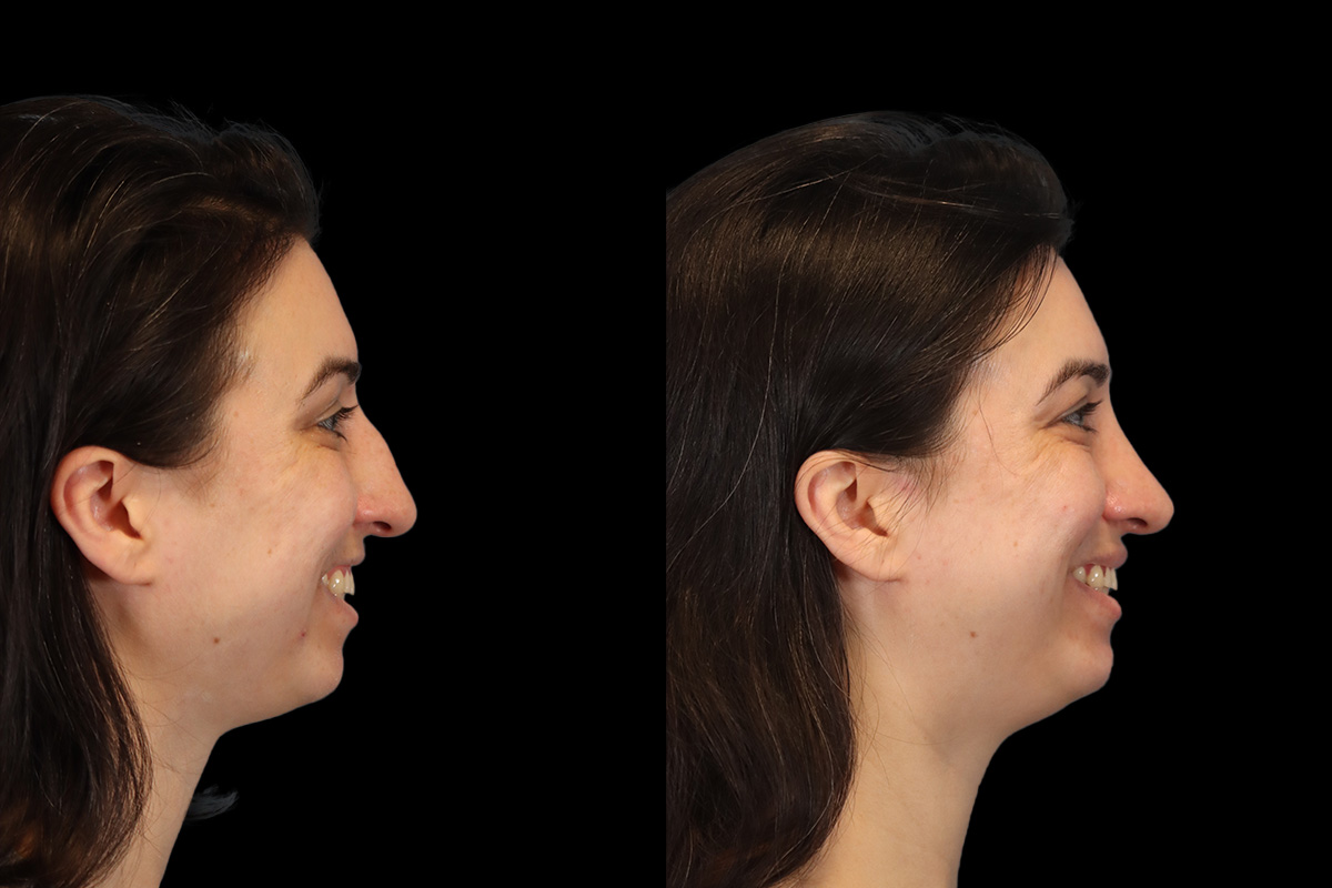 Nose Before & After Gallery - Patient 379393 - Image 5