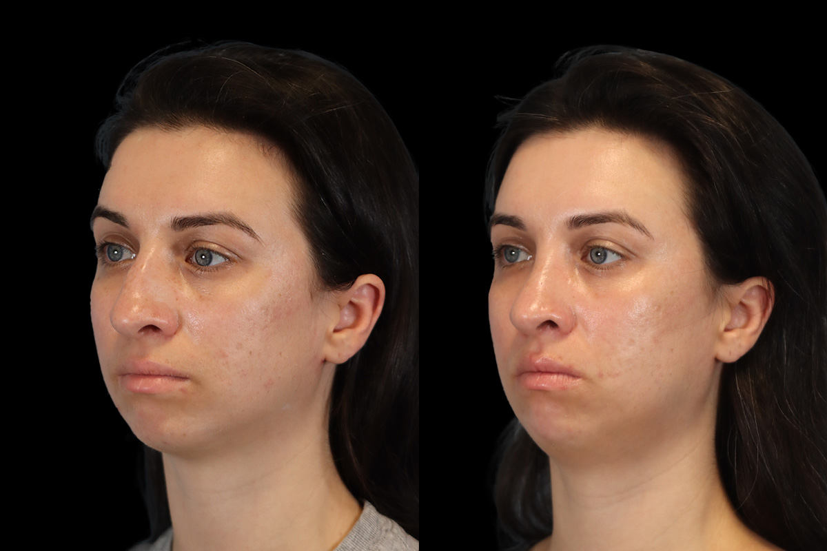 Nose Before & After Gallery - Patient 379393 - Image 6