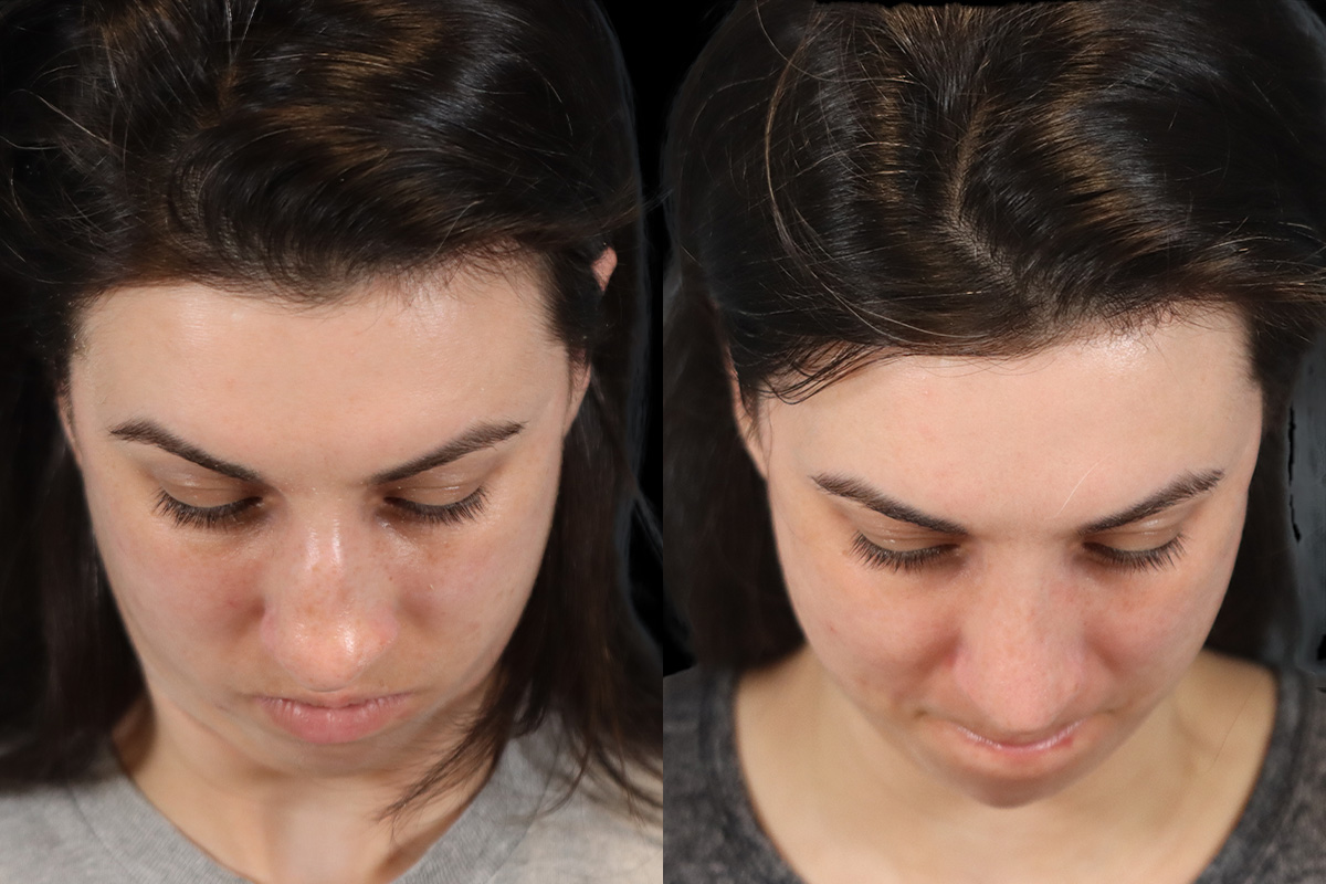 Nose Before & After Gallery - Patient 379393 - Image 7