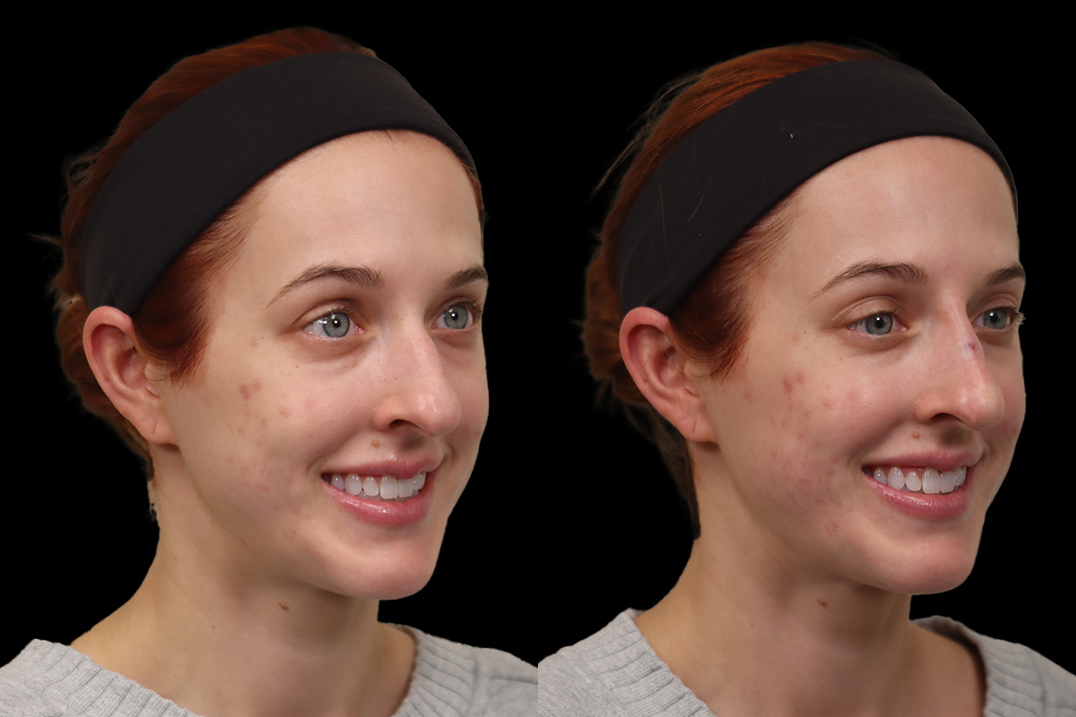 Nose Before & After Gallery - Patient 390768 - Image 4