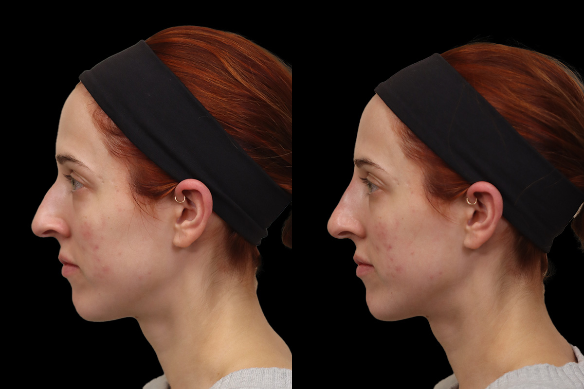 Nose Before & After Gallery - Patient 390768 - Image 5