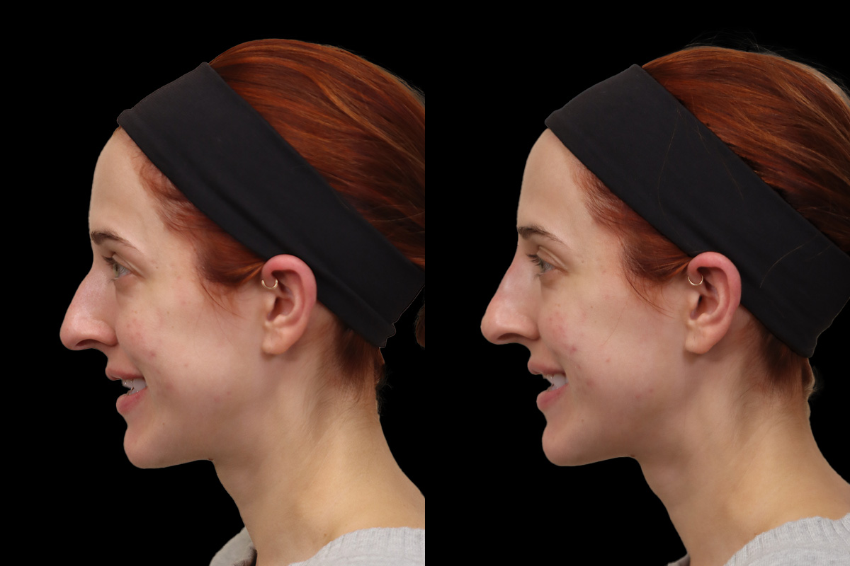 Nose Before & After Gallery - Patient 390768 - Image 6