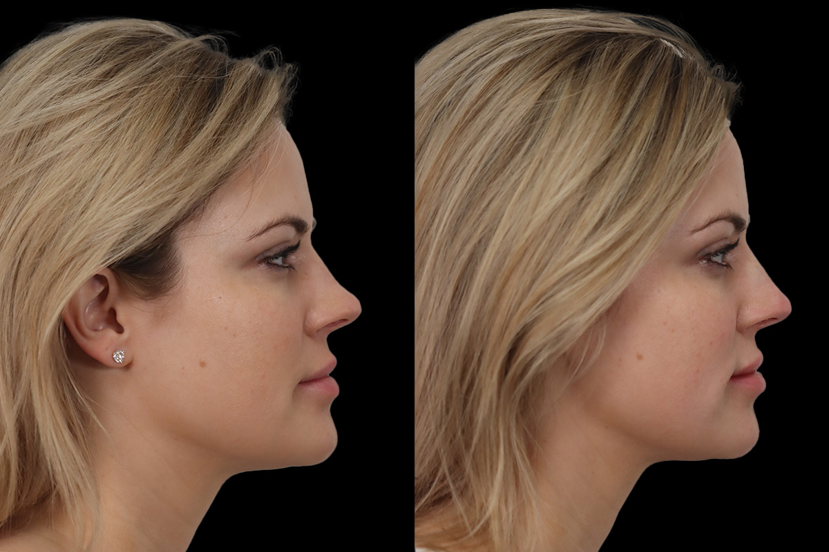 Nose Before & After Gallery - Patient 244578 - Image 2